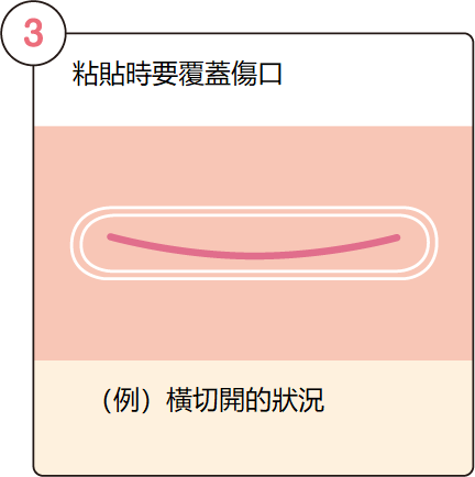 【日本直郵】日本LadyCare 3 術後傷口護理矽膠帖 疤痕增生修復可重複使用2個月 骨盆腔鏡手術可用 6片